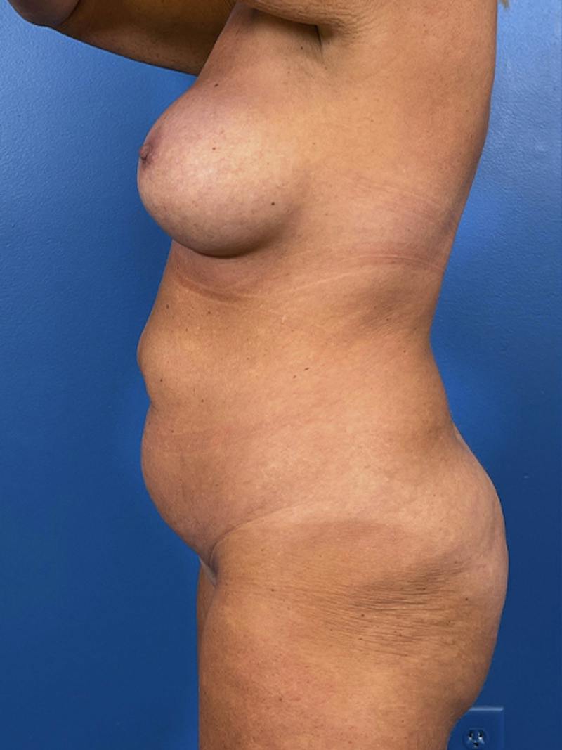Mommy Makeover Before & After Gallery - Patient 220242 - Image 3