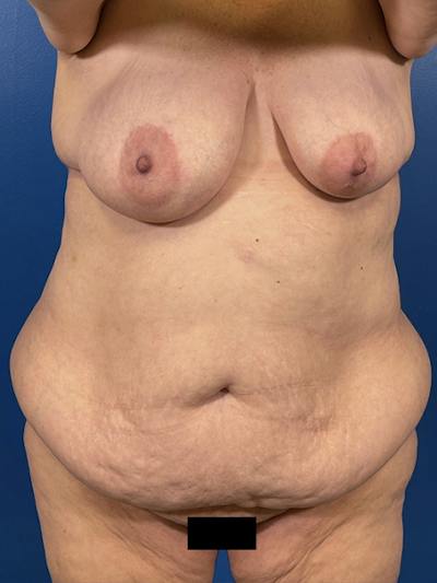 Mommy Makeover Before & After Gallery - Patient 294644 - Image 1