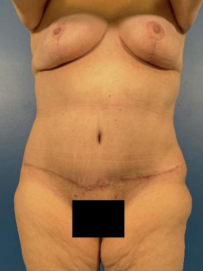 Mommy Makeover Before & After Gallery - Patient 294644 - Image 2