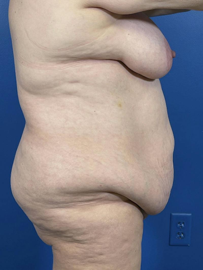 Mommy Makeover Before & After Gallery - Patient 294644 - Image 3