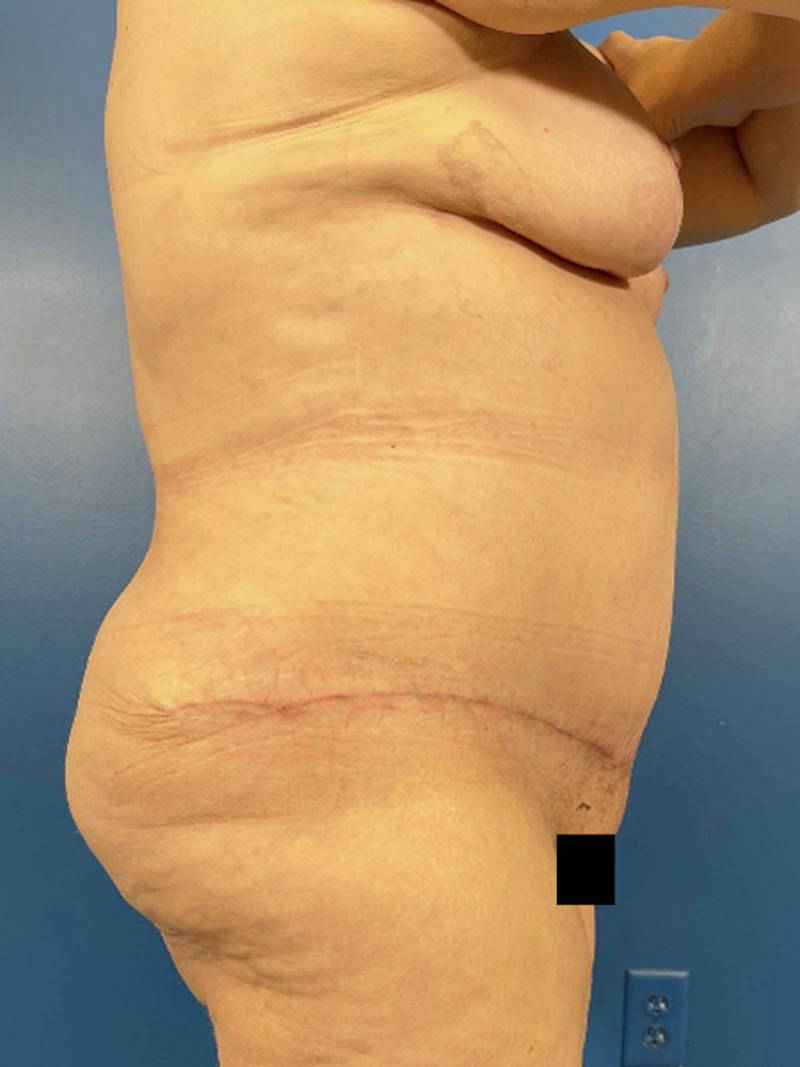 Mommy Makeover Before & After Gallery - Patient 294644 - Image 4