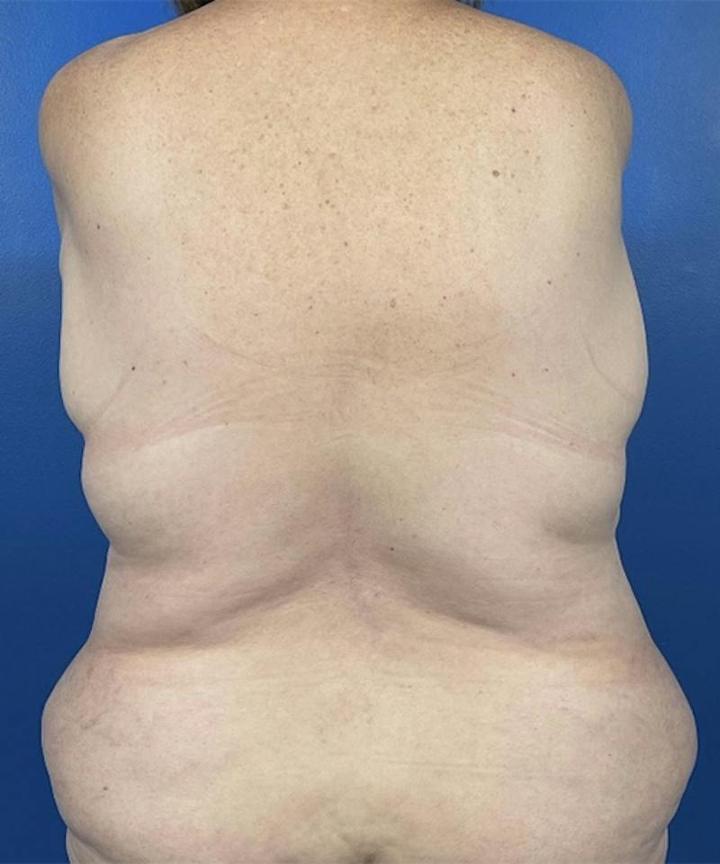 Mommy Makeover Before & After Gallery - Patient 294644 - Image 5