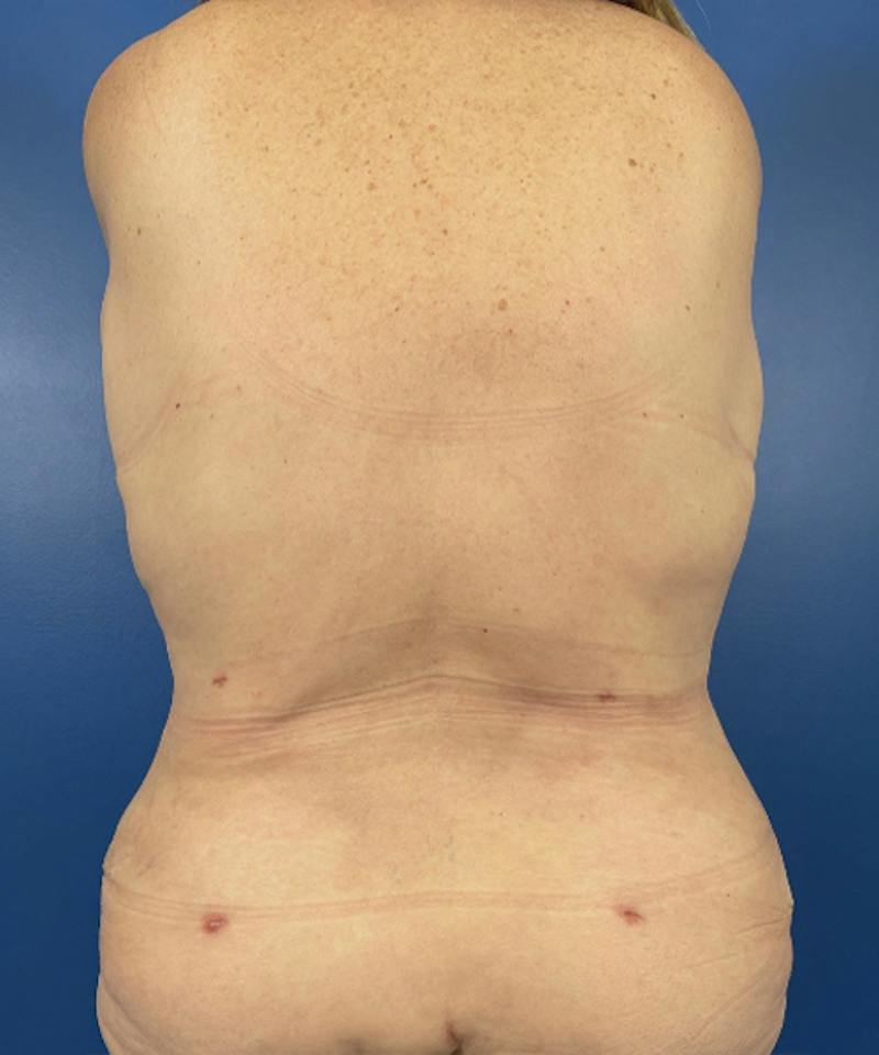 Mommy Makeover Before & After Gallery - Patient 294644 - Image 6