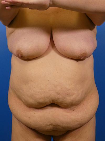 Mommy Makeover Before & After Gallery - Patient 308199 - Image 1