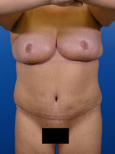 Mommy Makeover Before & After Gallery - Patient 308199 - Image 2