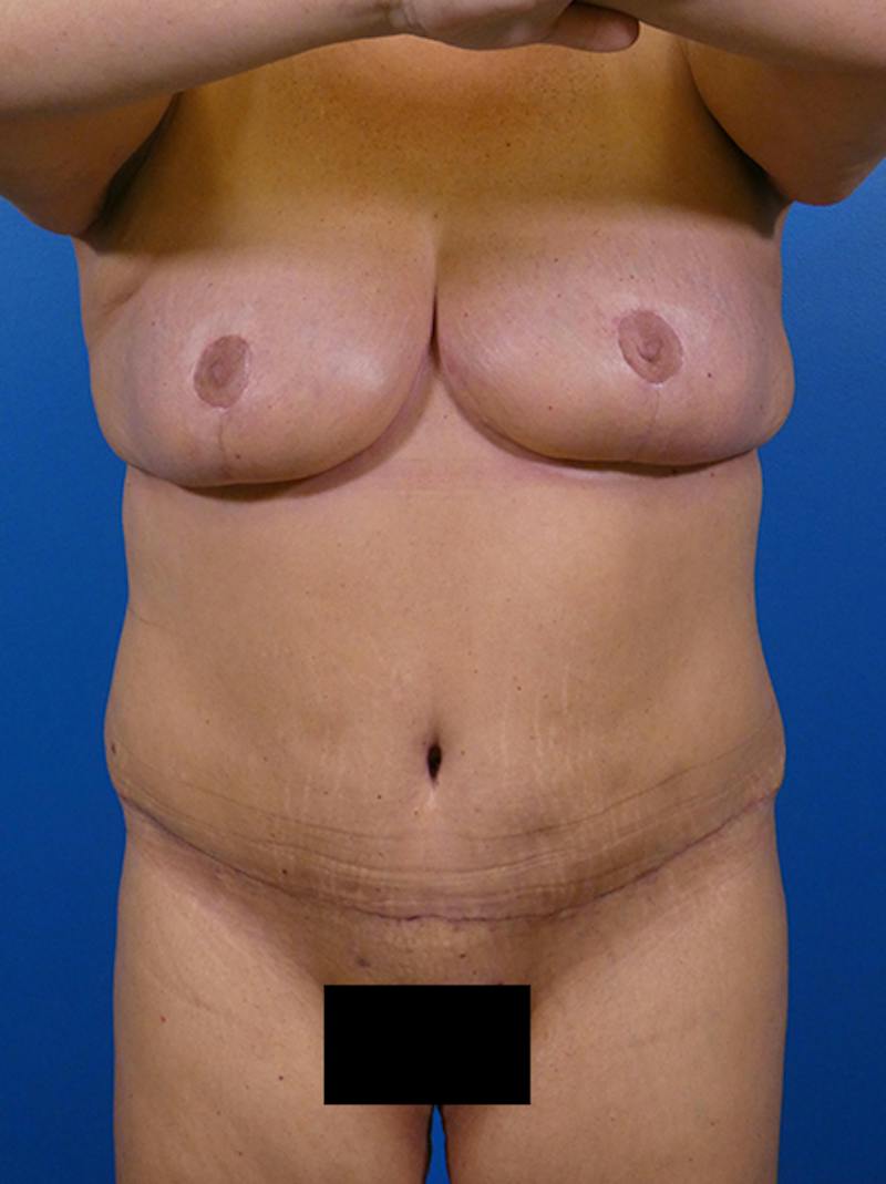Mommy Makeover Before & After Gallery - Patient 308199 - Image 2