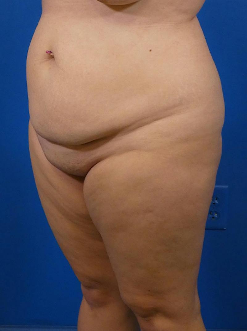 Tummy Tuck Before & After Gallery - Patient 382899 - Image 3