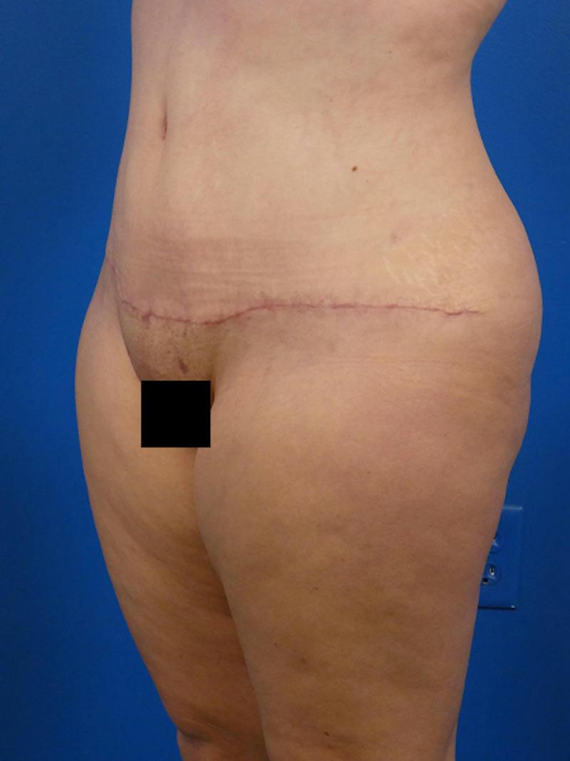 Tummy Tuck Before & After Gallery - Patient 382899 - Image 4