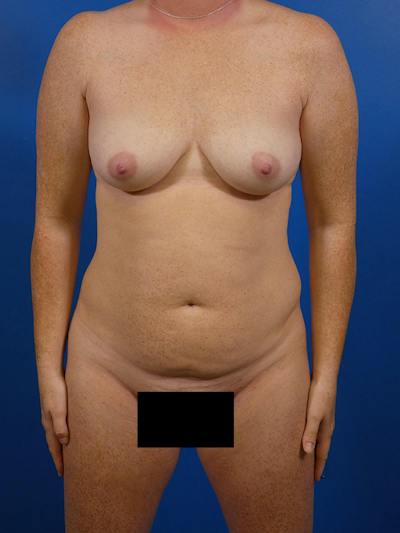 Mommy Makeover Before & After Gallery - Patient 953105 - Image 1