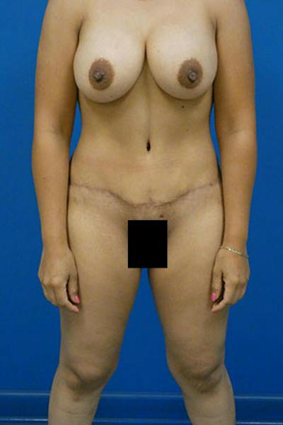 Mommy Makeover Before & After Gallery - Patient 308644 - Image 2