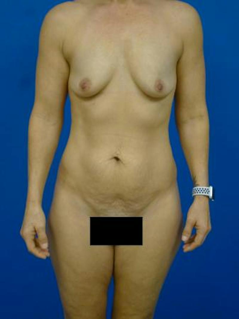 Mommy Makeover Before & After Gallery - Patient 331180 - Image 1