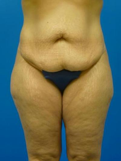 Mommy Makeover Before & After Gallery - Patient 146151 - Image 1