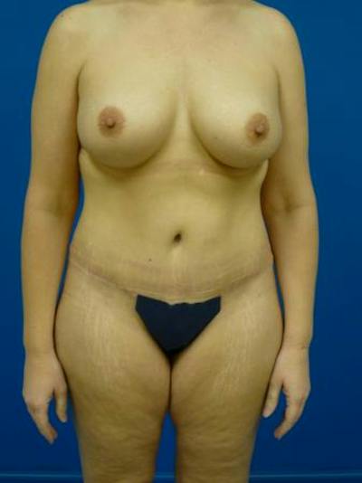 Mommy Makeover Before & After Gallery - Patient 146151 - Image 2