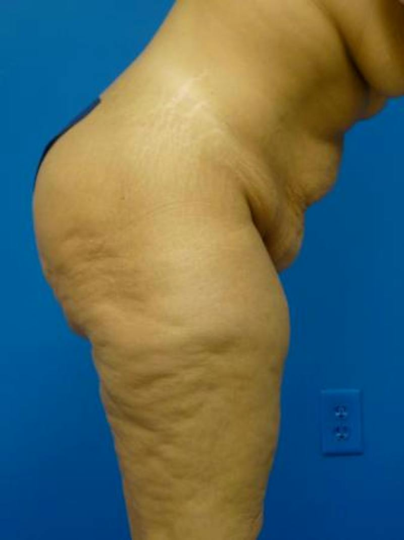 Mommy Makeover Before & After Gallery - Patient 146151 - Image 3