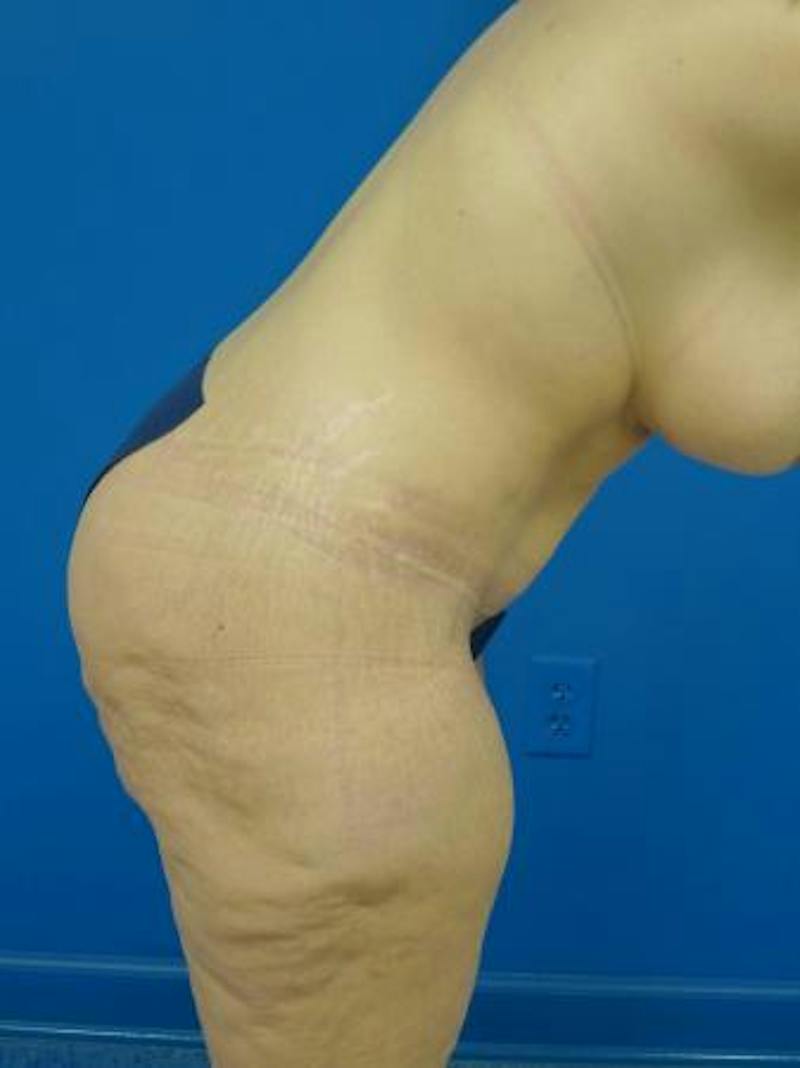 Mommy Makeover Before & After Gallery - Patient 146151 - Image 4