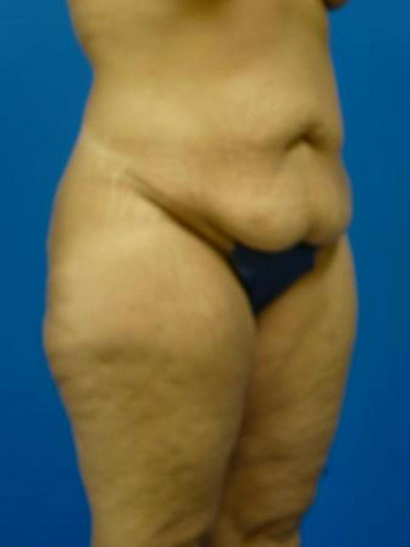Mommy Makeover Before & After Gallery - Patient 146151 - Image 5