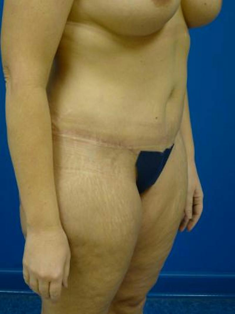 Mommy Makeover Before & After Gallery - Patient 146151 - Image 6