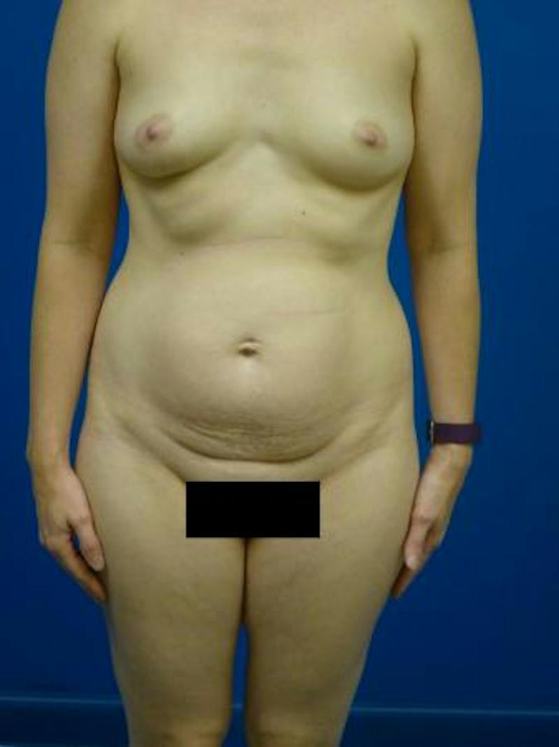Mommy Makeover Before & After Gallery - Patient 231031 - Image 1