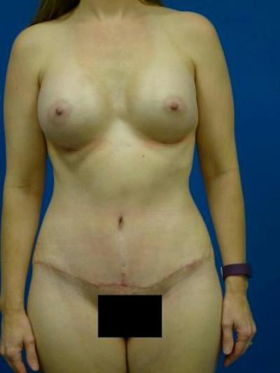Mommy Makeover Before & After Gallery - Patient 231031 - Image 2