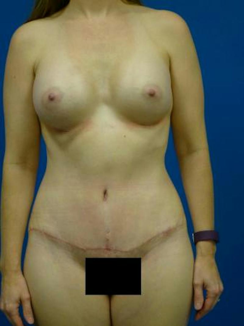 Mommy Makeover Before & After Gallery - Patient 231031 - Image 2
