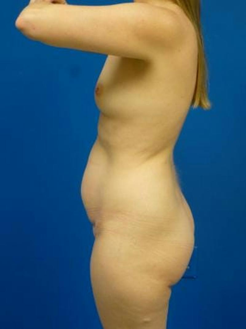 Mommy Makeover Before & After Gallery - Patient 231031 - Image 3