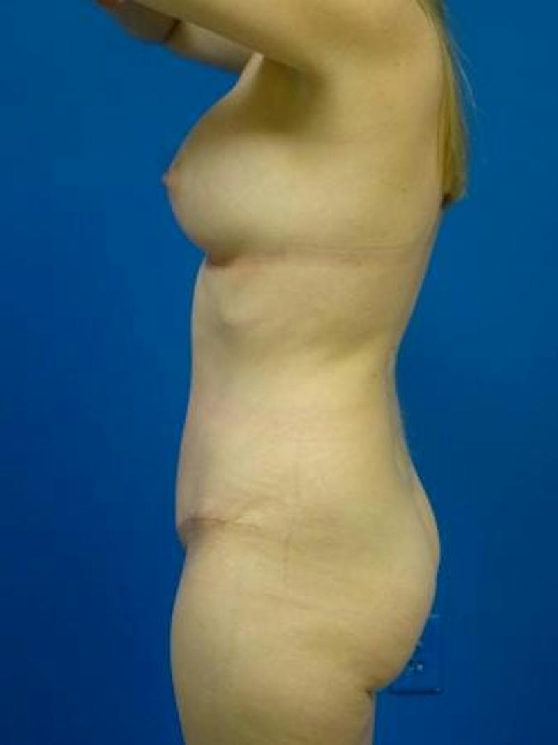 Mommy Makeover Before & After Gallery - Patient 231031 - Image 4