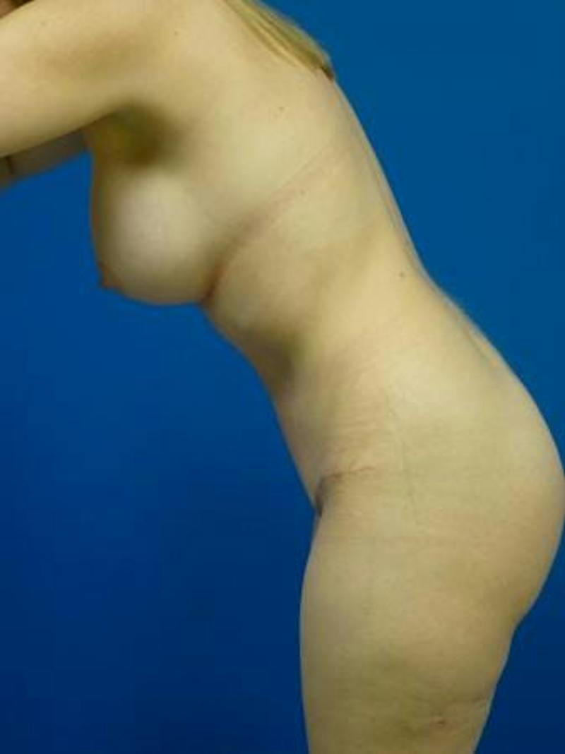 Mommy Makeover Before & After Gallery - Patient 231031 - Image 6