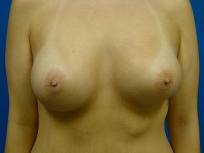 Mommy Makeover Before & After Gallery - Patient 384488 - Image 2