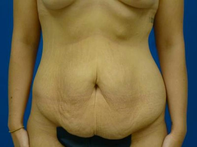 Mommy Makeover Before & After Gallery - Patient 384488 - Image 5