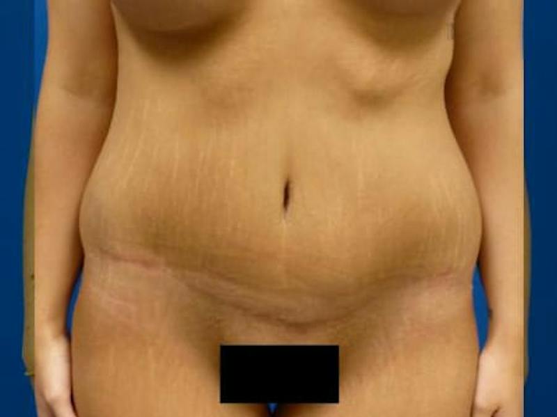 Mommy Makeover Before & After Gallery - Patient 384488 - Image 6