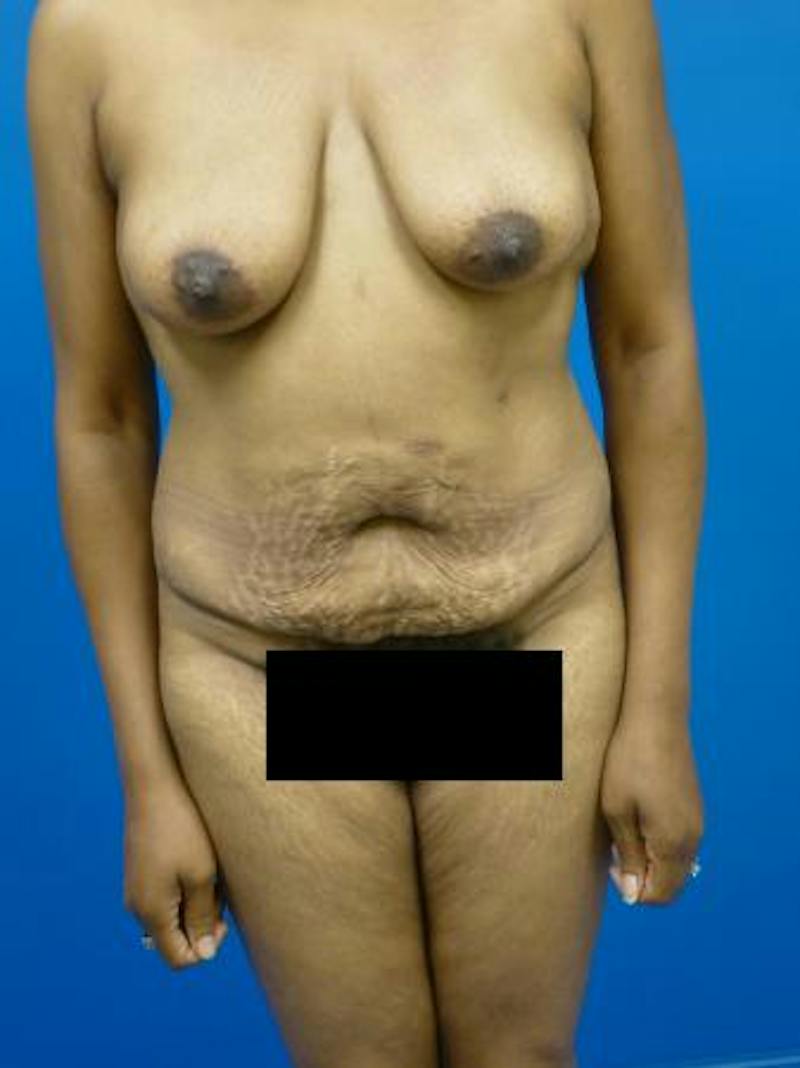 Mommy Makeover Before & After Gallery - Patient 232644 - Image 1