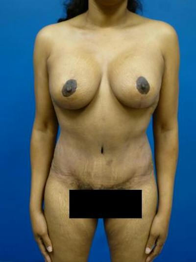 Mommy Makeover Before & After Gallery - Patient 232644 - Image 2