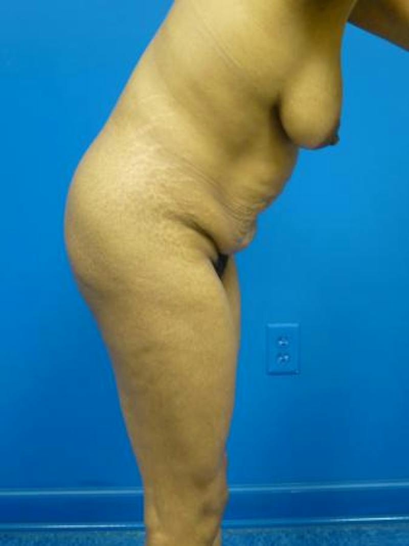 Mommy Makeover Before & After Gallery - Patient 232644 - Image 3