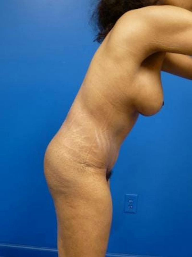 Mommy Makeover Before & After Gallery - Patient 232644 - Image 4