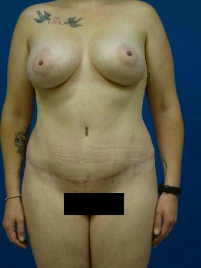 Mommy Makeover Before & After Gallery - Patient 248012 - Image 2