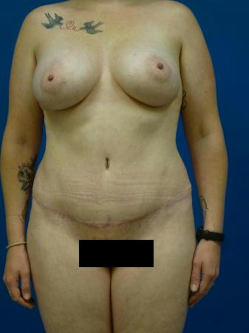 Mommy Makeover Before & After Gallery - Patient 248012 - Image 2