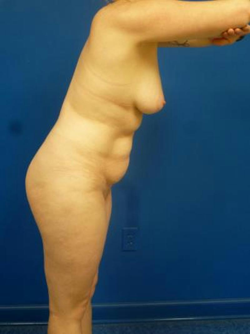 Mommy Makeover Before & After Gallery - Patient 248012 - Image 3