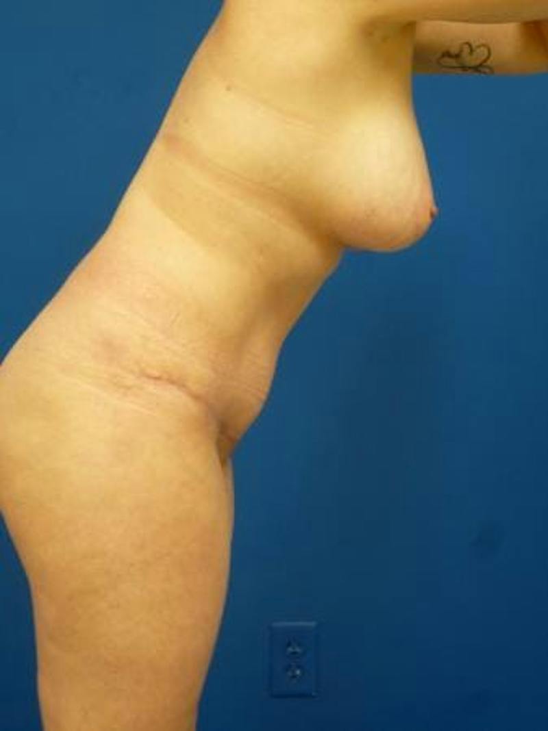 Mommy Makeover Before & After Gallery - Patient 248012 - Image 4