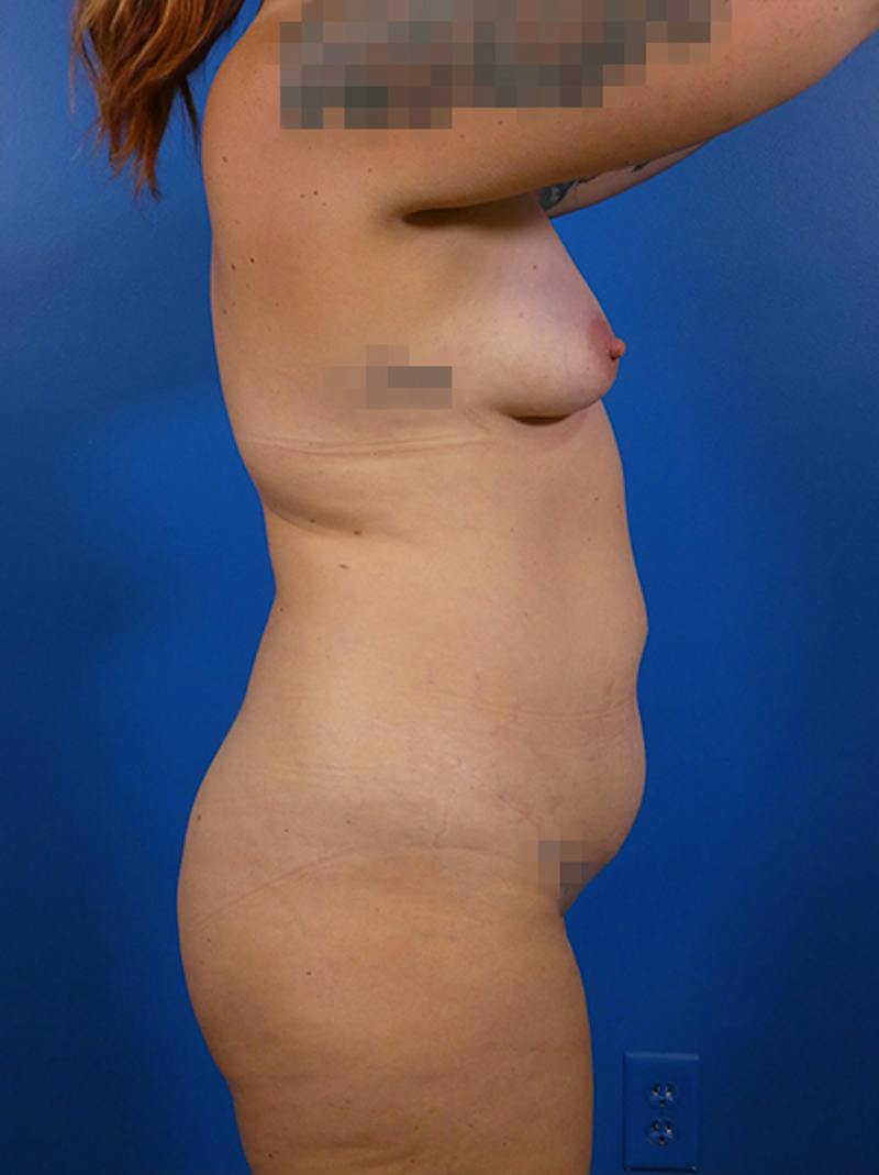 Mommy Makeover Before & After Gallery - Patient 149109 - Image 3