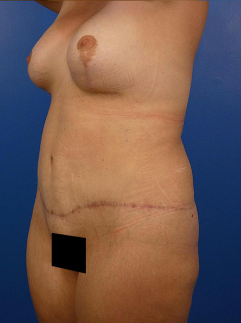 Mommy Makeover Before & After Gallery - Patient 595217 - Image 2