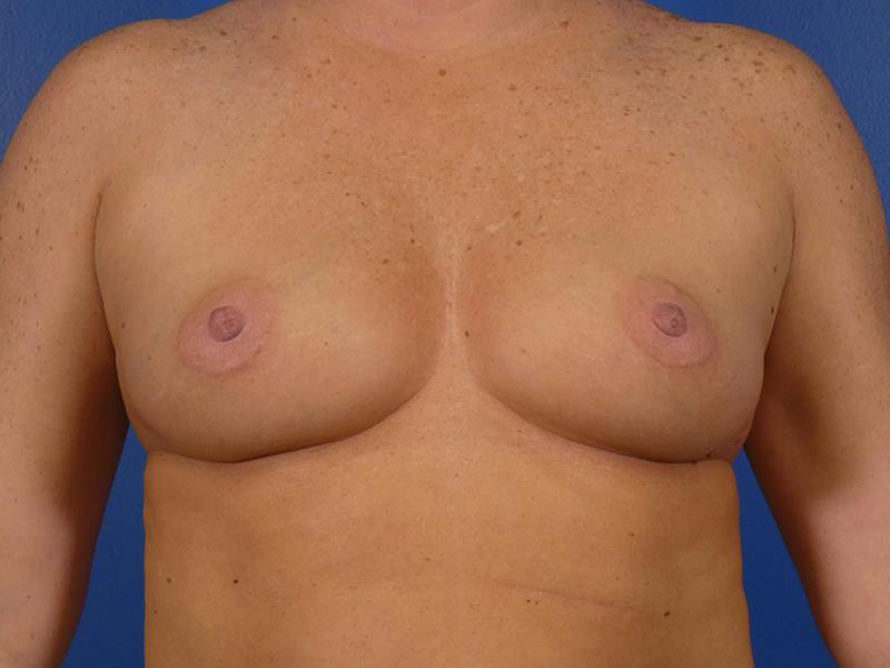 Mommy Makeover Before & After Gallery - Patient 222776 - Image 1