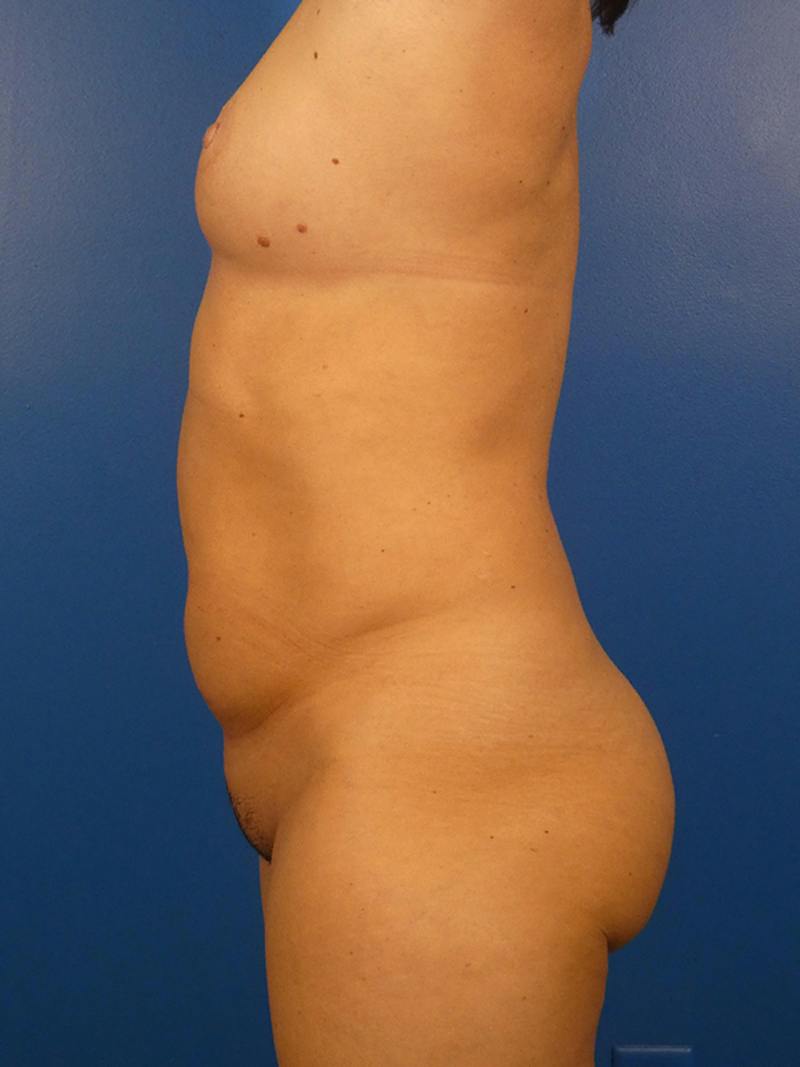 Mommy Makeover Before & After Gallery - Patient 222776 - Image 3
