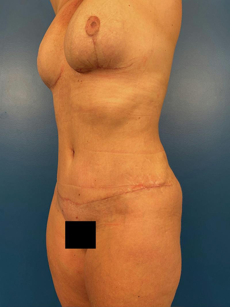 Mommy Makeover Before & After Gallery - Patient 200402 - Image 4