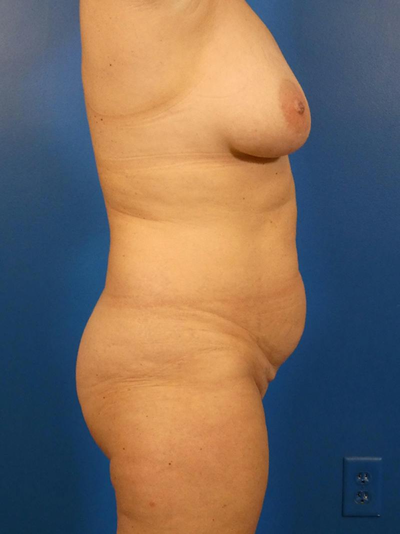 Mommy Makeover Before & After Gallery - Patient 200402 - Image 5