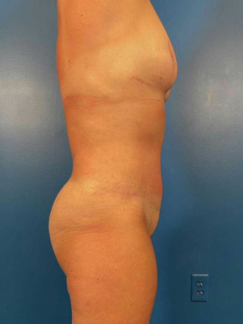 Mommy Makeover Before & After Gallery - Patient 200402 - Image 6