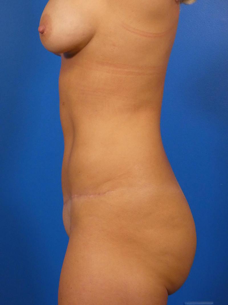 Mommy Makeover Before & After Gallery - Patient 172838 - Image 6