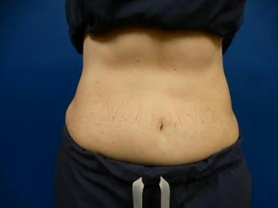Sculpsure Before & After Gallery - Patient 385471 - Image 1