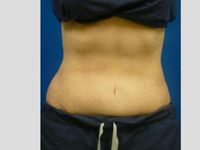 Sculpsure Before & After Gallery - Patient 385471 - Image 2