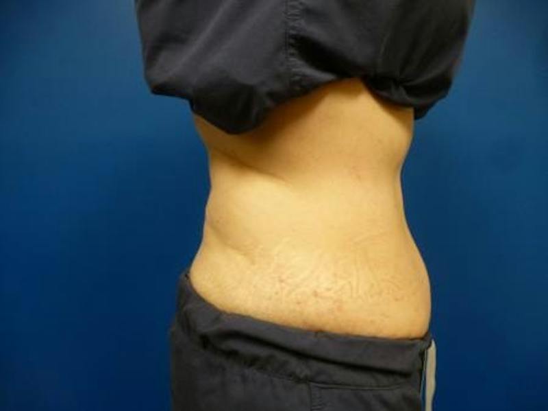 Sculpsure Before & After Gallery - Patient 385471 - Image 3
