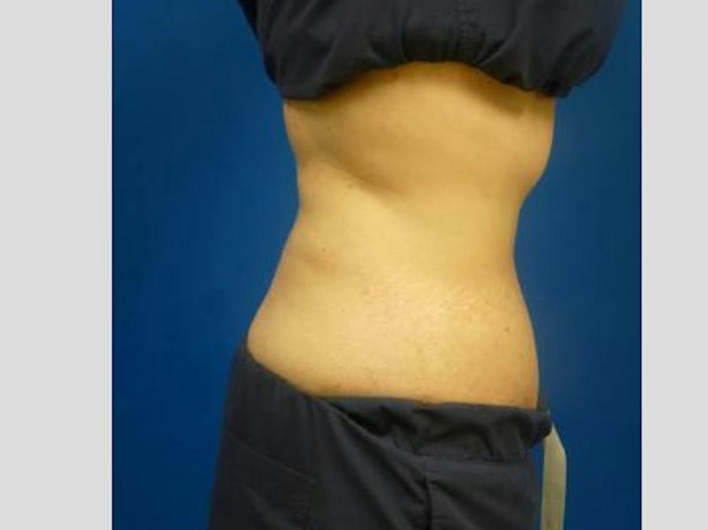 Sculpsure Before & After Gallery - Patient 385471 - Image 4